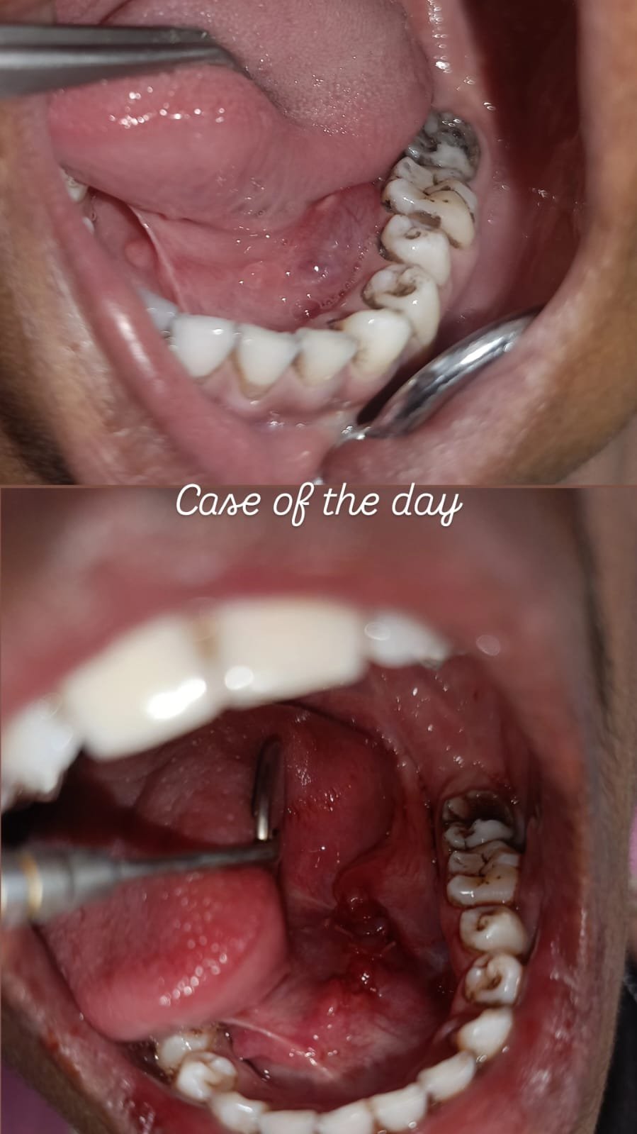 Before and After view of a root canal treated tooth and subsequent restoration
